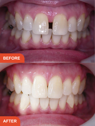 Before and after adult braces in Essex