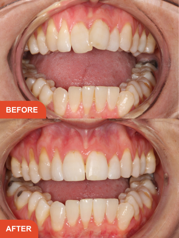 Before and after adult braces in Essex