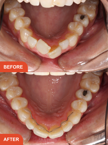 Before and after adult braces in Essex