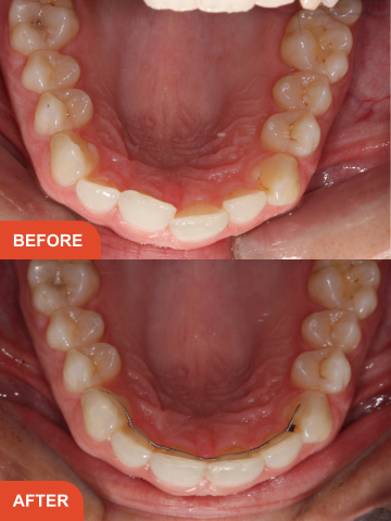 Before and after adult braces in Essex