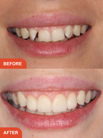 Lisa Hancock Before After Treatment