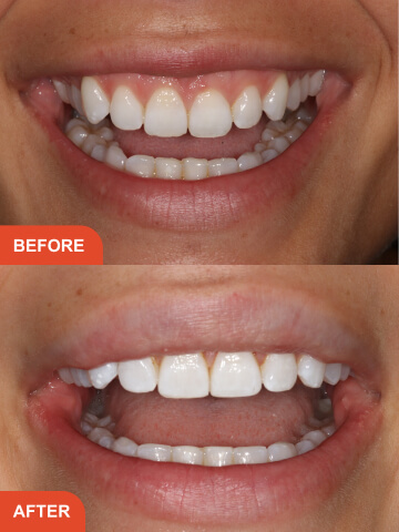 Morton Holly Before After Treatment