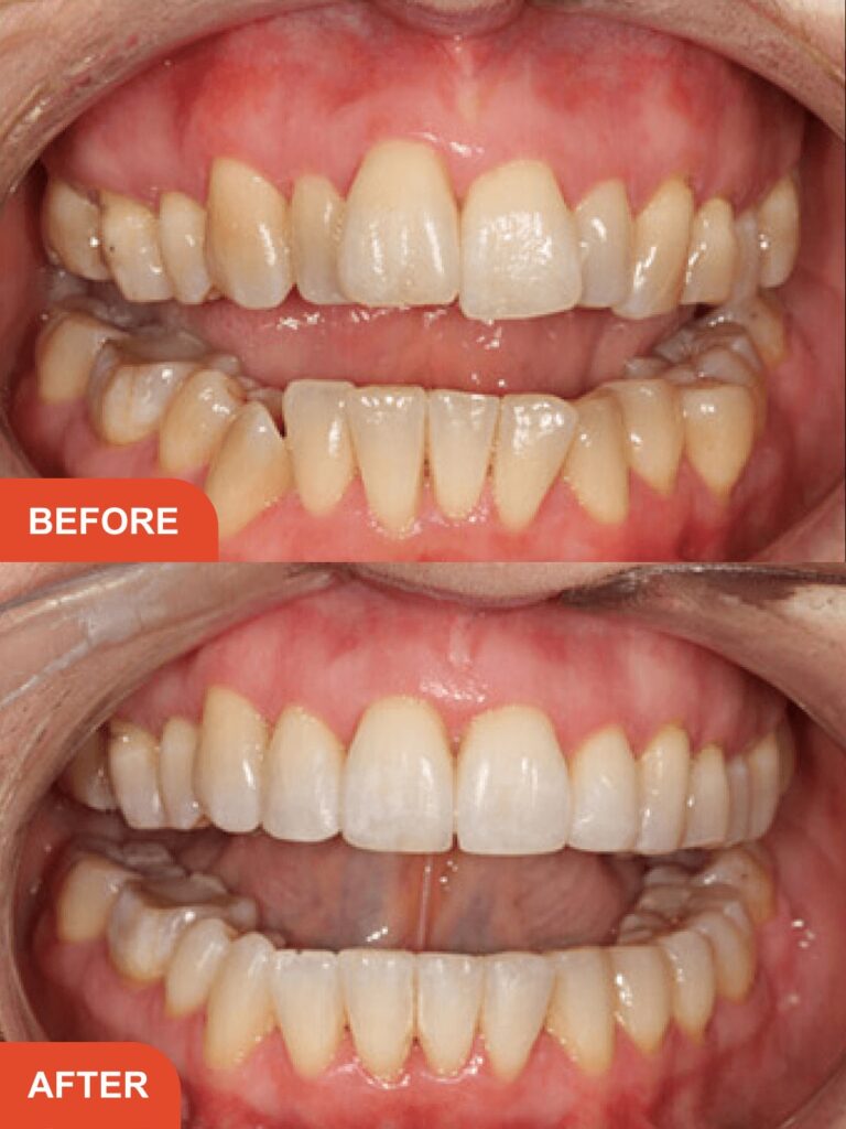 Adult Invisalign Essex 
