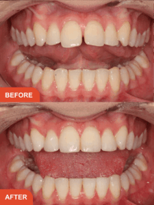 Invisalign before and after