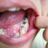 Say Goodbye to Amalgam Fillings