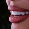 Smile makeover Essex
