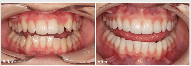 Teeth whitening Essex