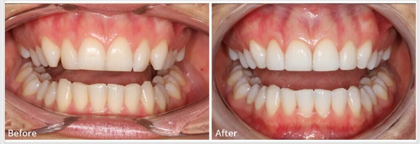 Teeth whitening Essex