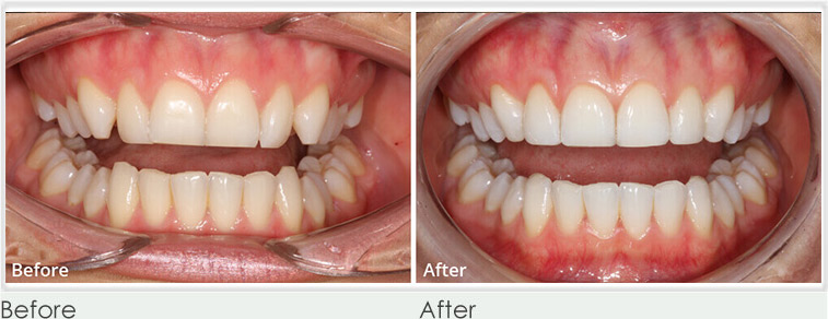 teeth whitening before after