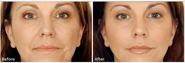 derma filler before and after result
