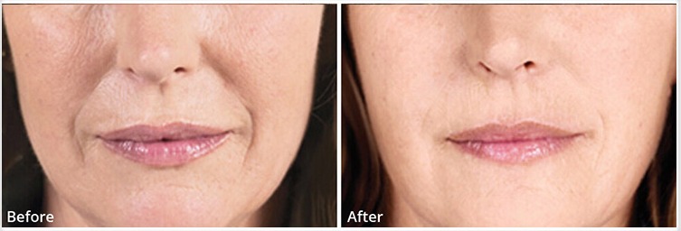  treatment before and after