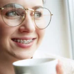 Composite Bonding vs Veneers