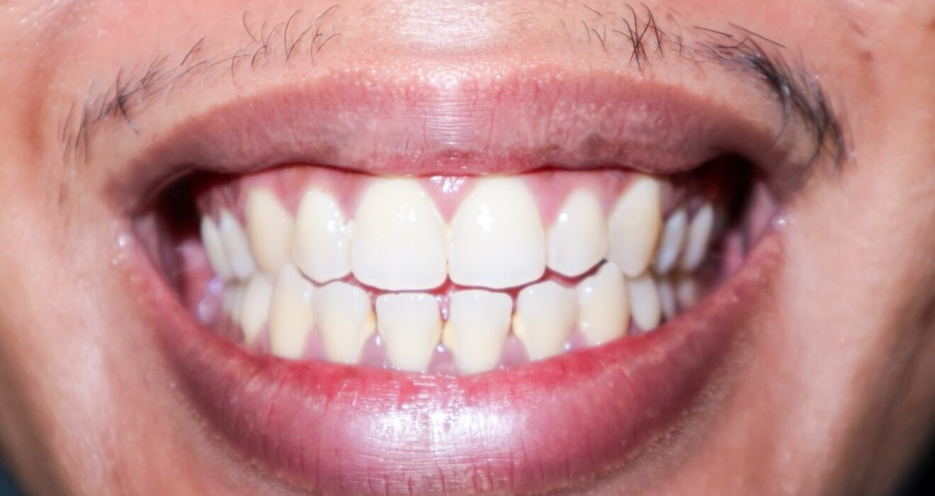 teeth whitening Essex