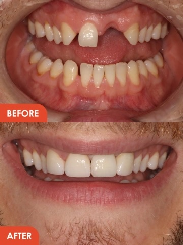 Dental implants before and after