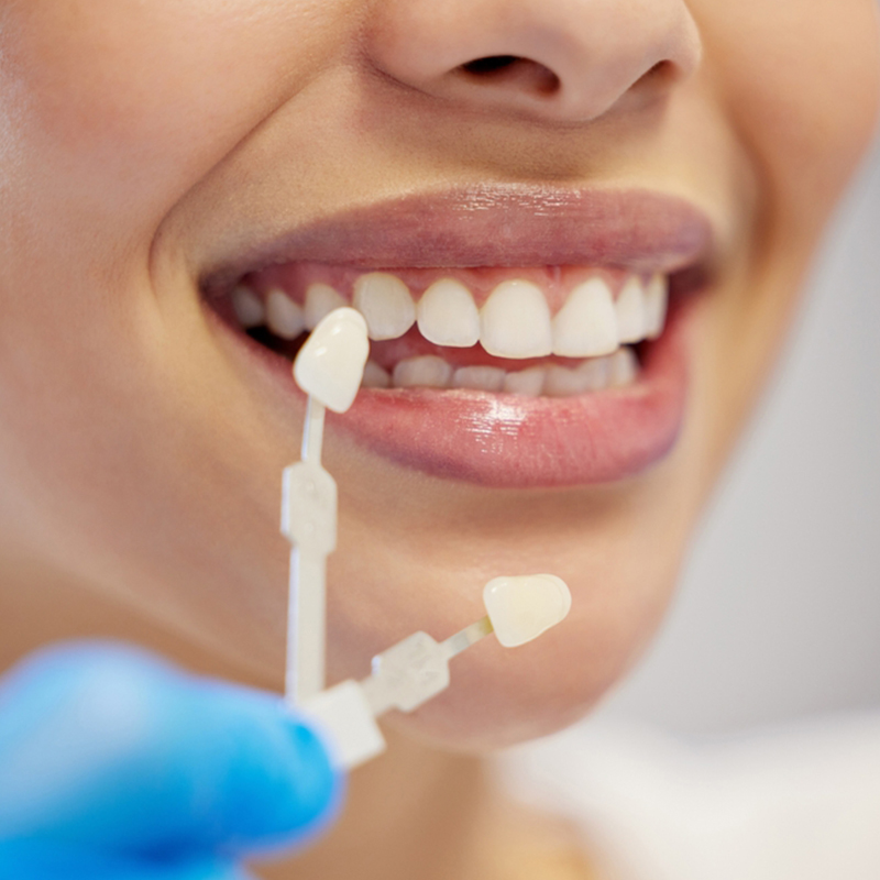 Teeth Whitening