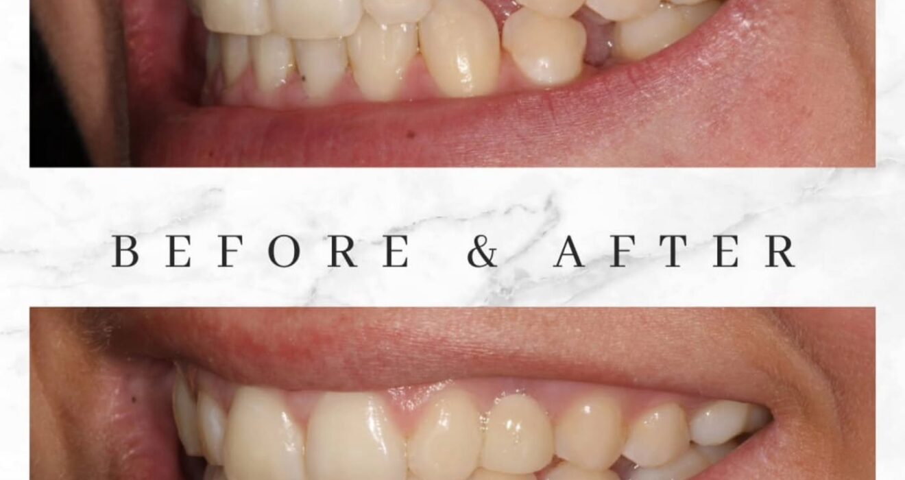 What Happens to Postponed Dental Work: The Bone Loss Timeline