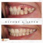 What Happens to Postponed Dental Work: The Bone Loss Timeline