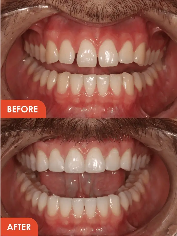 Composite Bonding Results
